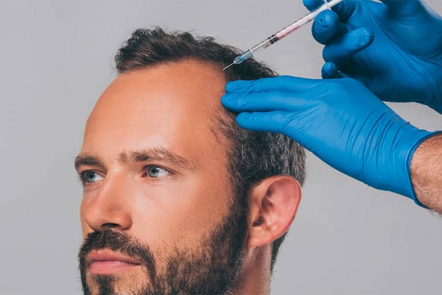 homme calvitie the clinic bruxelles expert implant traitement capillaire greffe de cheveux medecine esthetique belgique