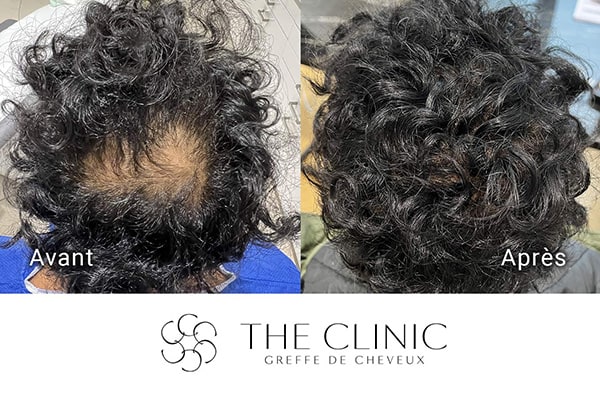 avant apres 81 greffe de cheveux implants cheveux the clinic bruxelles expert implants capillaire greffe de cheveux belgique bruxelles