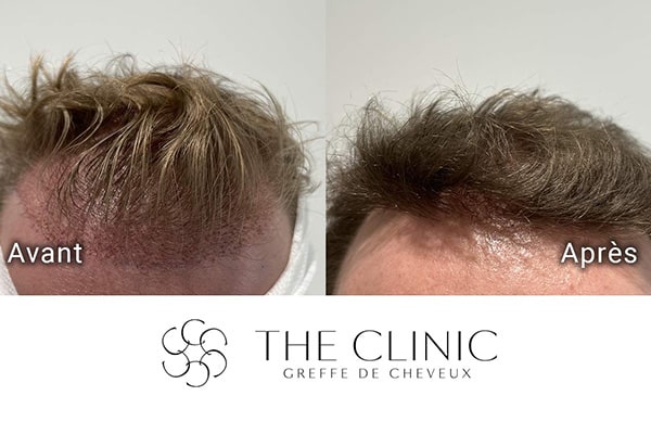 avant apres 82 greffe de cheveux implants cheveux the clinic bruxelles expert implants capillaire greffe de cheveux belgique bruxelles