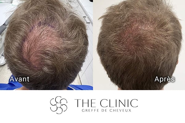 avant apres 83 greffe de cheveux implants cheveux the clinic bruxelles expert implants capillaire greffe de cheveux belgique bruxelles