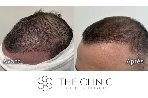 avant apres 84 greffe de cheveux implants cheveux the clinic bruxelles expert implants capillaire greffe de cheveux belgique bruxelles