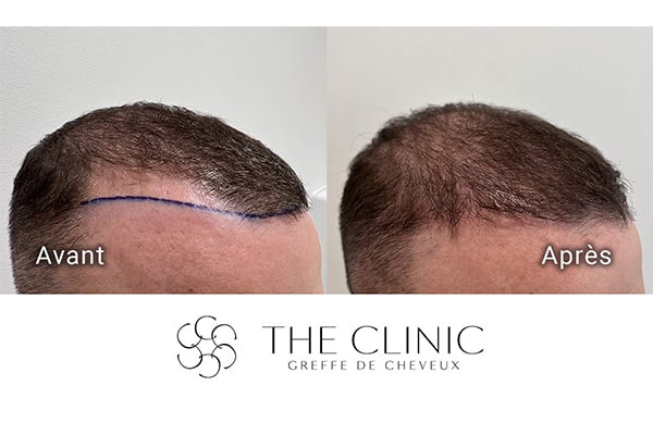 avant apres 85 greffe de cheveux implants cheveux the clinic bruxelles expert implants capillaire greffe de cheveux belgique bruxelles