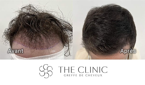 avant apres 87 greffe de cheveux implants cheveux the clinic bruxelles expert implants capillaire greffe de cheveux belgique bruxelles