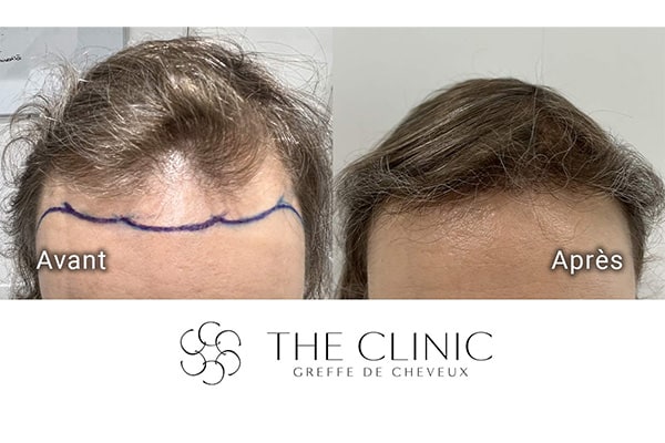 avant apres 88 greffe de cheveux implants cheveux the clinic bruxelles expert implants capillaire greffe de cheveux belgique bruxelles