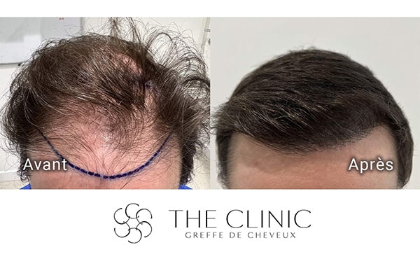 avant apres 89 greffe de cheveux implants cheveux the clinic bruxelles expert implants capillaire greffe de cheveux belgique bruxelles