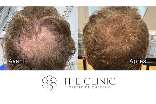 avant apres 90 greffe de cheveux implants cheveux the clinic bruxelles expert implants capillaire greffe de cheveux belgique bruxelles