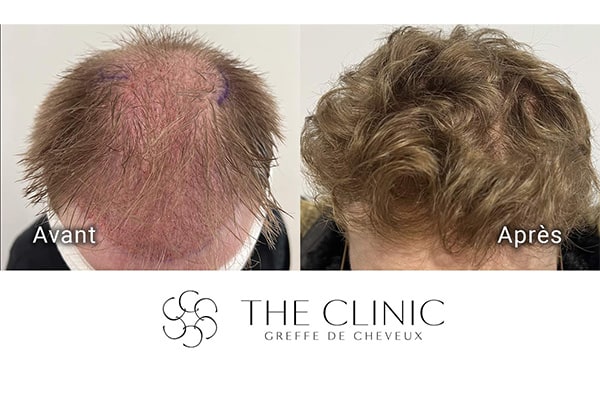 avant apres 91 greffe de cheveux implants cheveux the clinic bruxelles expert implants capillaire greffe de cheveux belgique bruxelles