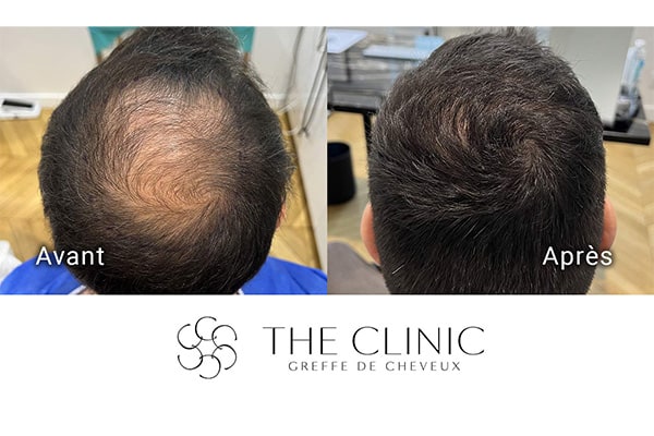 avant apres 92 greffe de cheveux implants cheveux the clinic bruxelles expert implants capillaire greffe de cheveux bruxelles