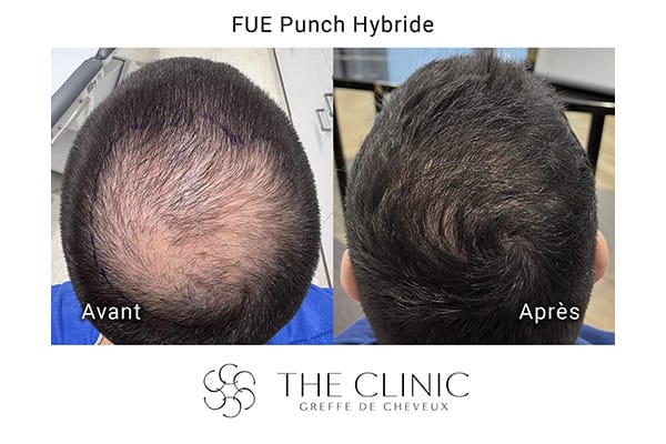 avant apres fue punch hybride 1 greffe de cheveux implants cheveux the clinic bruxelles expert implants capillaire greffe de cheveux bruxelles