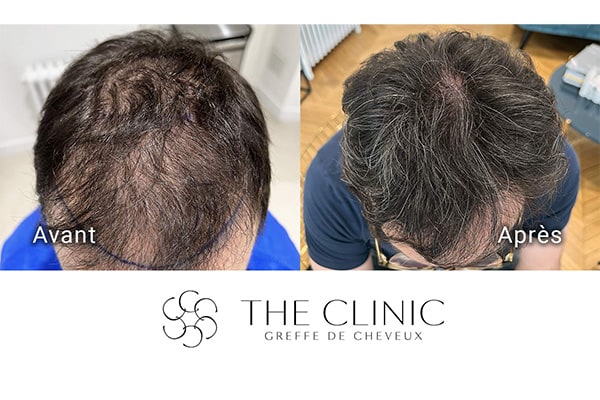 avant apres fue punch hybride 100 greffe de cheveux implants cheveux the clinic bruxelles expert implants capillaire greffe de cheveux bruxelles