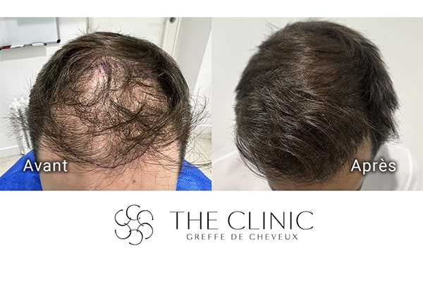 avant apres fue punch hybride 101 greffe de cheveux implants cheveux the clinic bruxelles expert implants capillaire greffe de cheveux bruxelles