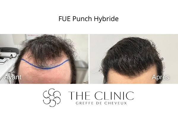 avant apres fue punch hybride 102 greffe de cheveux implants cheveux the clinic bruxelles expert implants capillaire greffe de cheveux bruxelles
