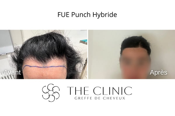 avant apres fue punch hybride 103 greffe de cheveux implants cheveux the clinic bruxelles expert implants capillaire greffe de cheveux bruxelles