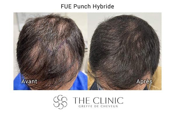 avant apres fue punch hybride 2 greffe de cheveux implants cheveux the clinic bruxelles expert implants capillaire greffe de cheveux belgique bruxelles