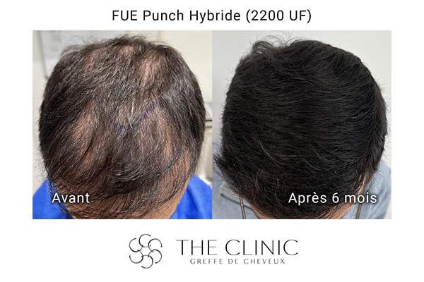 avant apres fue punch hybride 3 greffe de cheveux implants cheveux the clinic bruxelles expert implants capillaire greffe de cheveux bruxelles