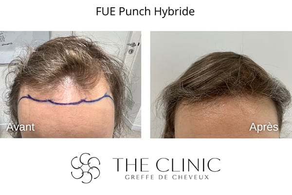 avant apres fue punch hybride 4 greffe de cheveux implants cheveux the clinic bruxelles expert implants capillaire greffe de cheveux bruxelles