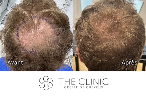 avant apres fue punch hybride 79 greffe de cheveux implants cheveux the clinic bruxelles expert implants capillaire greffe de cheveux bruxelles