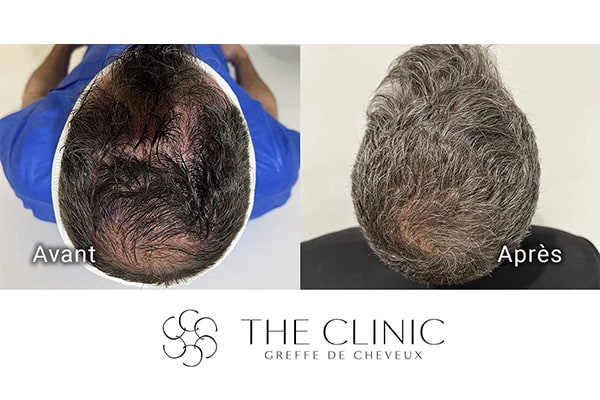 avant apres fue punch hybride 93 greffe de cheveux implants cheveux the clinic bruxelles expert implants capillaire greffe de cheveux bruxelles