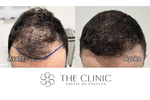 avant apres fue punch hybride 94 greffe de cheveux implants cheveux the clinic bruxelles expert implants capillaire greffe de cheveux bruxelles