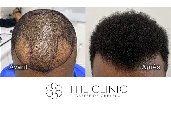avant apres fue punch hybride 96 greffe de cheveux implants cheveux the clinic bruxelles expert implants capillaire greffe de cheveux bruxelles