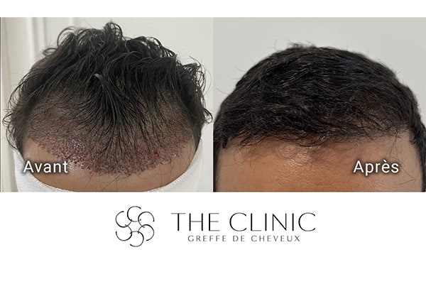avant apres fue punch hybride 97 greffe de cheveux implants cheveux the clinic bruxelles expert implants capillaire greffe de cheveux bruxelles
