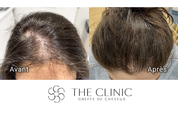 avant apres fue punch hybride 98 greffe de cheveux implants cheveux the clinic bruxelles expert implants capillaire greffe de cheveux bruxelles