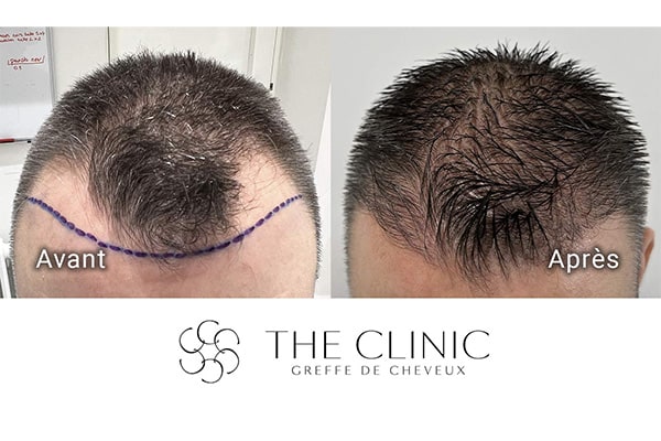 avant apres fue punch hybride 99 greffe de cheveux implants cheveux the clinic bruxelles expert implants capillaire greffe de cheveux bruxelles