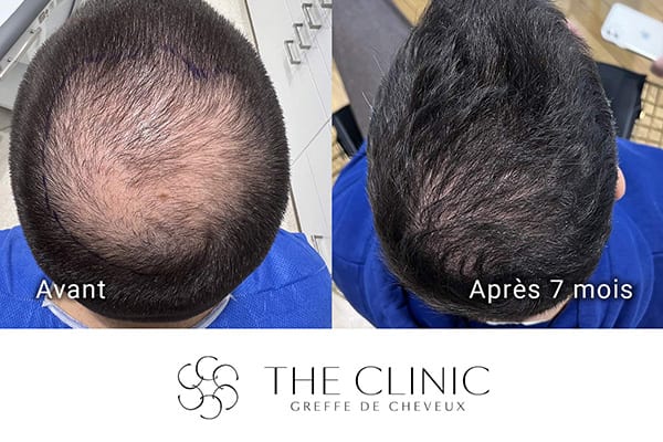 avant apres fue punch hybride greffe de cheveux implants cheveux the clinic bruxelles expert implants capillaire greffe de cheveux belgique bruxelles
