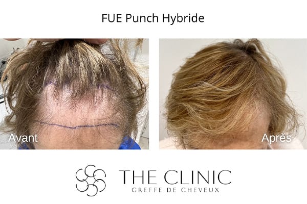 avant apres greffe de cheveux implants cheveux fue punch hybride the clinic bruxelles expert implants capillaire greffe de cheveux belgique bruxelles