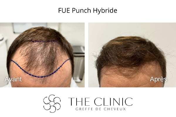 avant apres greffe de cheveux implants cheveux punch hybride the clinic bruxelles expert implants capillaire greffe de cheveux belgique bruxelles