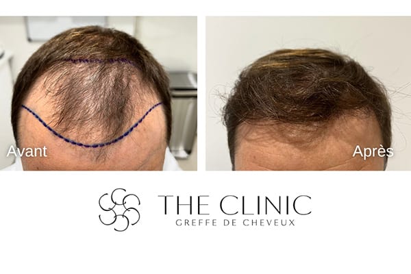 avant apres greffe de cheveux implants cheveux punch hybride the clinic bruxelles expert implants capillaire greffe de cheveux belgique bruxelles