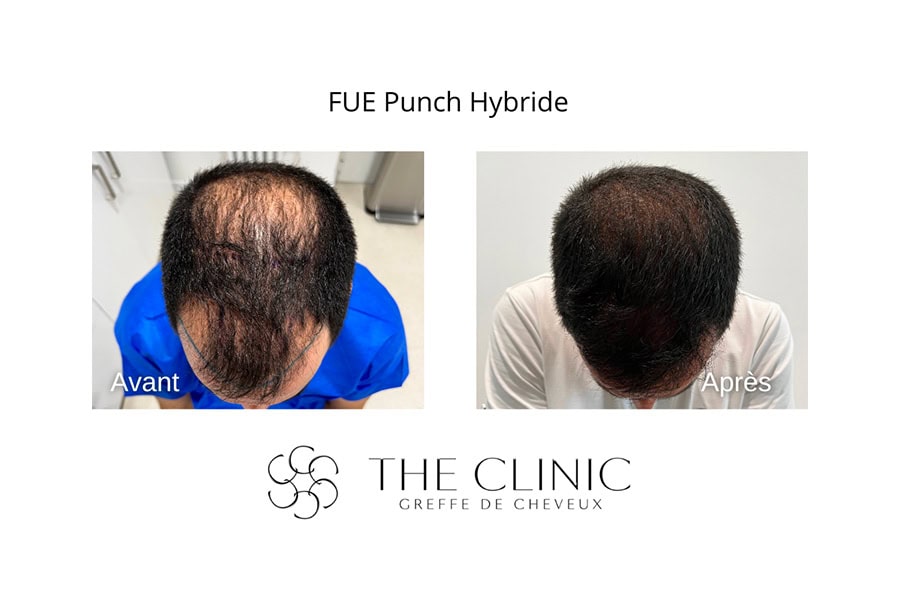 greffe capillaire fue punch hybride the clinic bruxelles expert implant traitement capillaire greffe de cheveux medecine esthetique belgique