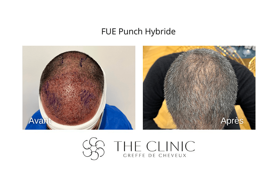 greffe capillaire fue punch hybride the clinic bruxelles expert implant capillaire greffe de cheveux medecine esthetique belgique