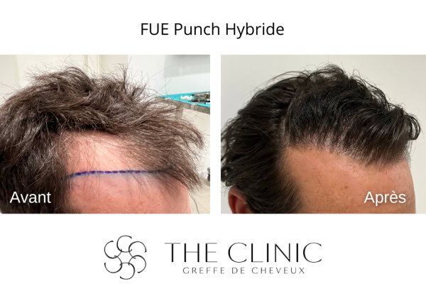 avant apres fue punch hybride 17 greffe capillaire the clinic bruxelles expert implant capillaire greffe de cheveux medecine esthetique belgique