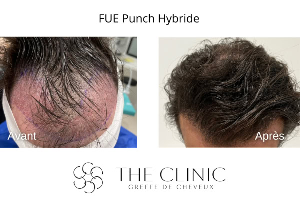 fue punch hybride avant apres 16 greffe capillaire greffe capillaire the clinic bruxelles expert implant capillaire greffe de cheveux medecine esthetique belgique