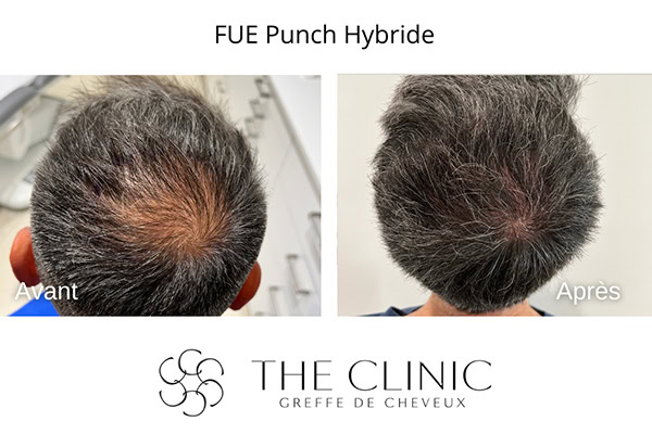 avant apres fue punch hybride 18 greffe de cheveux implants cheveux the clinic bruxelles expert implants capillaire greffe de cheveux bruxelles