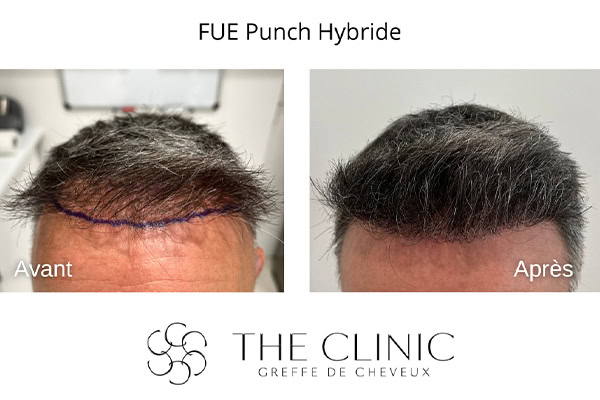 avant apres fue punch hybride 19 greffe de cheveux implants cheveux the clinic bruxelles expert implants capillaire greffe de cheveux bruxelles