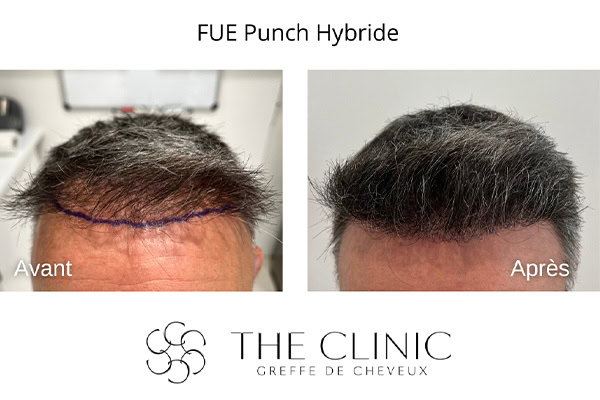 avant apres fue punch hybride 19 greffe de cheveux implants cheveux the clinic bruxelles expert implants capillaire greffe de cheveux bruxelles