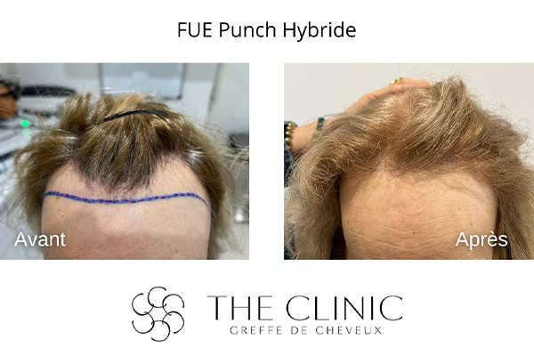 avant apres fue punch hybride 20 greffe de cheveux implants cheveux the clinic bruxelles expert implants capillaire greffe de cheveux bruxelles