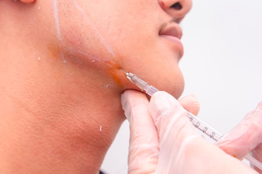 injections acide hyaluronique jawline visage the clinic bruxelles expert medecine esthetique belgique greffe de cheveux belgique
