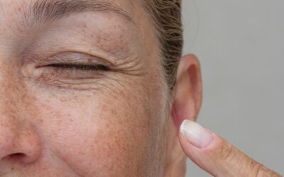 Injection acide hyaluronique des cernes ratée : que faire ?
