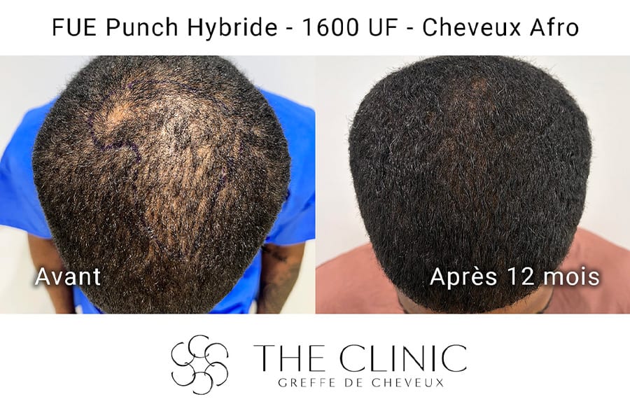 avant apres fue punch hybride 1600 uf cheveux afro greffe de cheveux implants cheveux the clinic bruxelles expert implants capillaire greffe de cheveux bruxelles