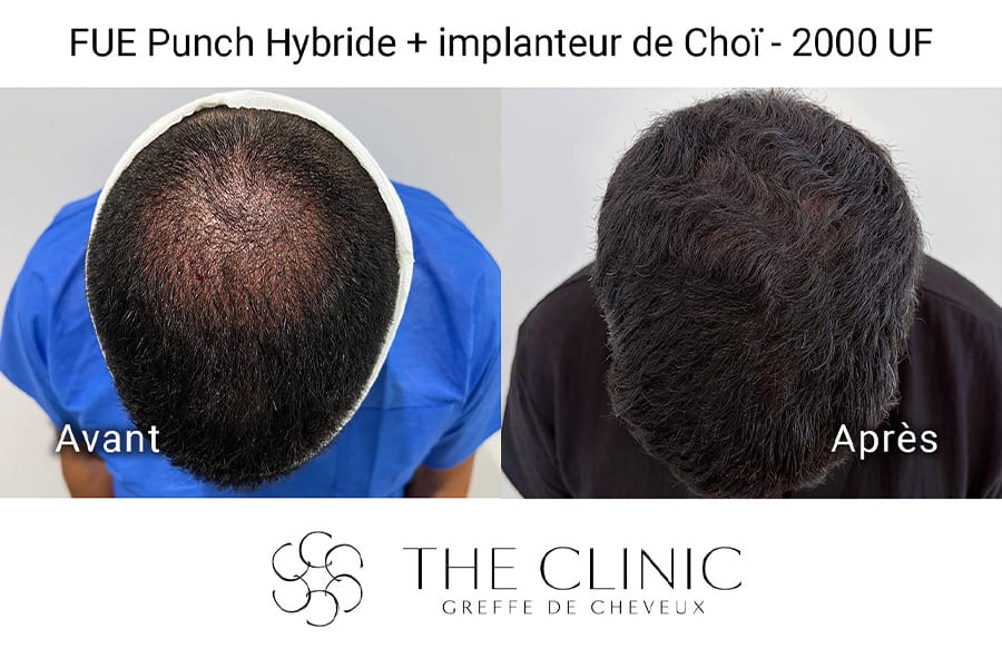 avant apres fue punch hybride implanteur de choi 2000 uf greffe de cheveux implants cheveux the clinic bruxelles expert implants capillaire greffe de cheveux bruxelles