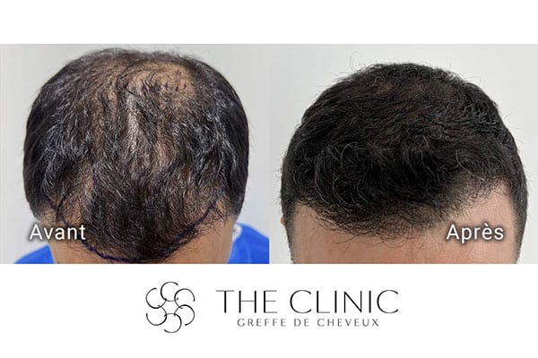 avant apres fue punch hyvride greffe de cheveux implants cheveux the clinic bruxelles expert implants capillaire greffe de cheveux france bruxelles 104