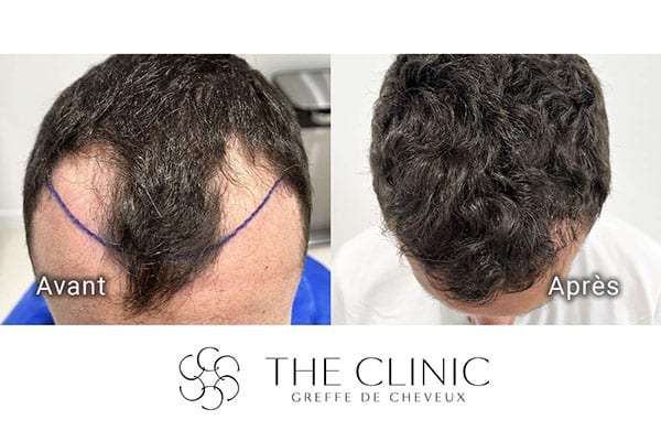 avant apres fue punch hyvride greffe de cheveux implants cheveux the clinic bruxelles expert implants capillaire greffe de cheveux france bruxelles 105