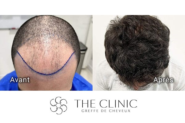avant apres fue punch hyvride greffe de cheveux implants cheveux the clinic bruxelles expert implants capillaire greffe de cheveux france bruxelles 106