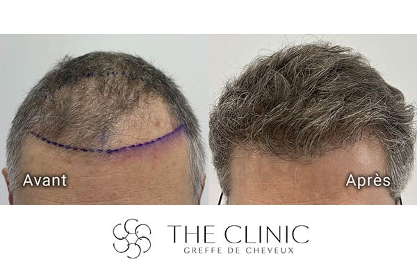 avant apres fue punch hyvride greffe de cheveux implants cheveux the clinic bruxelles expert implants capillaire greffe de cheveux france bruxelles 107