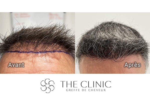 avant apres fue punch hyvride greffe de cheveux implants cheveux the clinic bruxelles expert implants capillaire greffe de cheveux france bruxelles 108