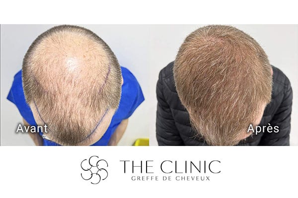 avant apres fue punch hyvride greffe de cheveux implants cheveux the clinic bruxelles expert implants capillaire greffe de cheveux france bruxelles 109