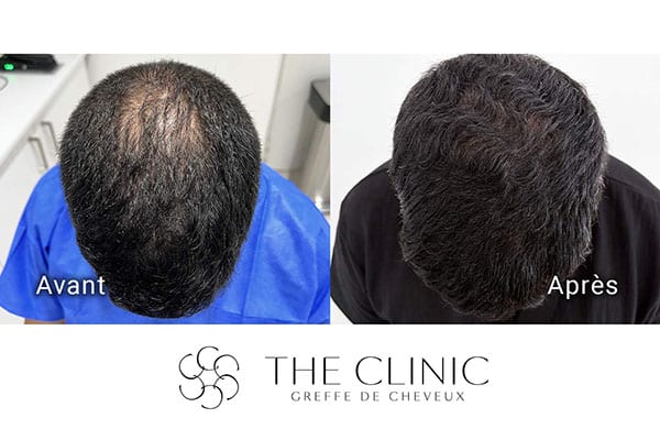 avant apres fue punch hyvride greffe de cheveux implants cheveux the clinic bruxelles expert implants capillaire greffe de cheveux france bruxelles 110
